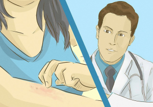 Schimmelinfectie huid behandelen